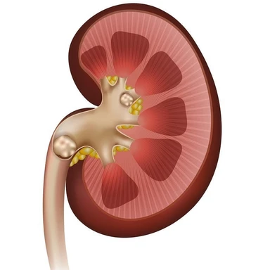 Kidney Stone Medicines