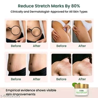 HEALOFY Advanced Stretch Marks Removal Cream 100g