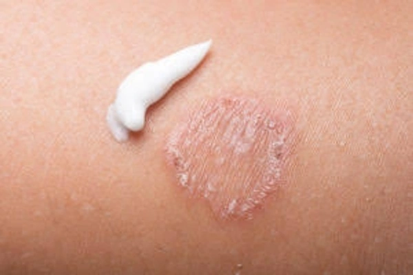 Ascabiol Lotion - 50ml