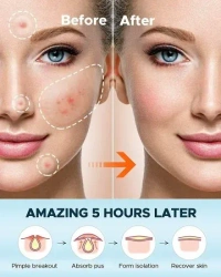 36PCS PIMPLE PATCH - "36 pcs Acne Patch Pimple Patch Beauty Products by shop99variety" (1997)