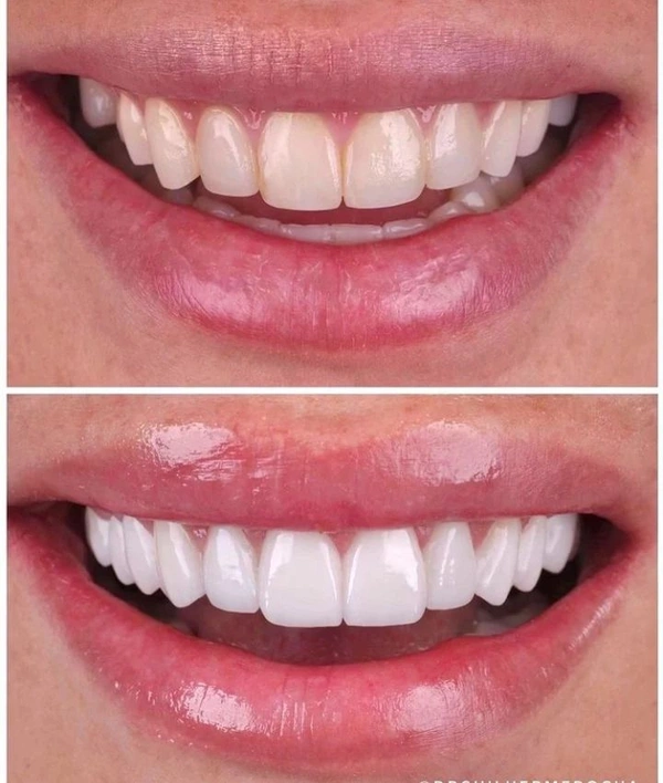 💫Teeth Whitening Powder 100% Natural⚡