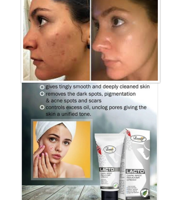 ✨Lacto Dark Spot Remover Cream😱