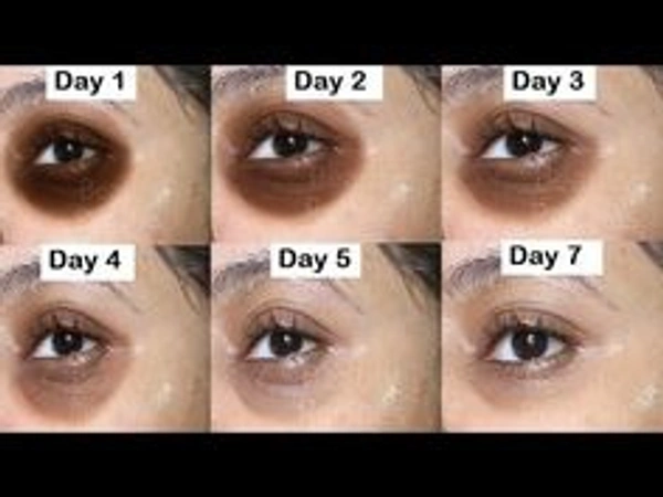 ✨Under Eye Serum For Dark Circles, Anti-Aging,Puffiness & Pure Radiant Skin*