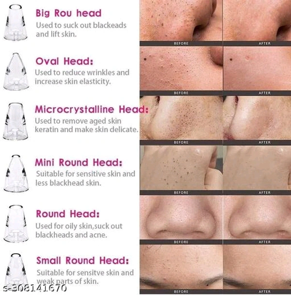Classic Acne PCENF5334 Treatment Devices*Capacity: 150gIdeal For: UnisexNet Quantity (N): 1Dispatch: 2 Days*Proof of Safe Delivery! Click to know on Safety Standards of Delivery Partners- https://ltl.sh/y_nZrAV3