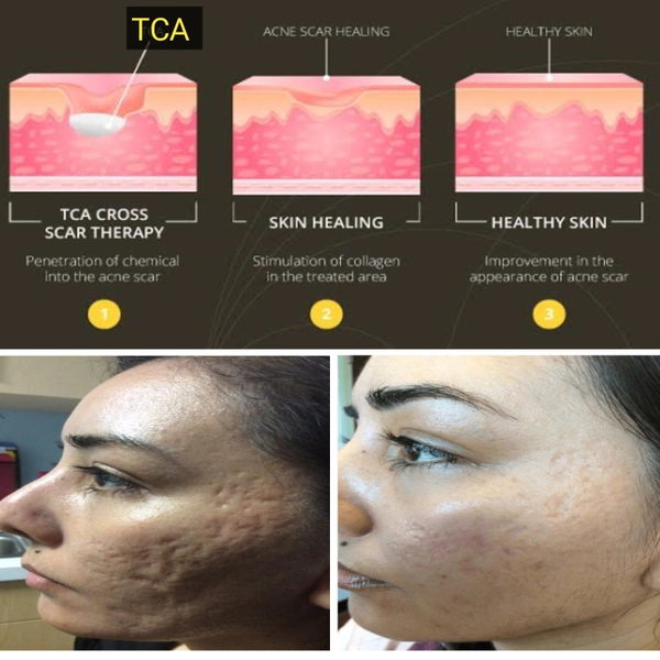 TCA Cross 50% For Acne Scars, moles, and warts etc