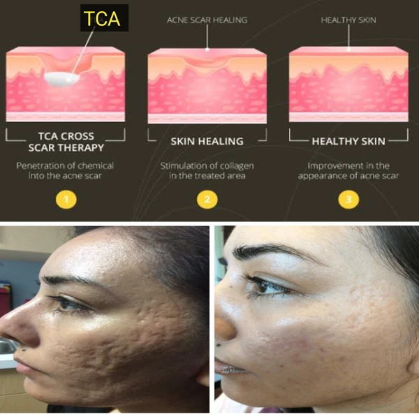 TCA Cross 80% For Deep Acne Scars,Moles,Warts.