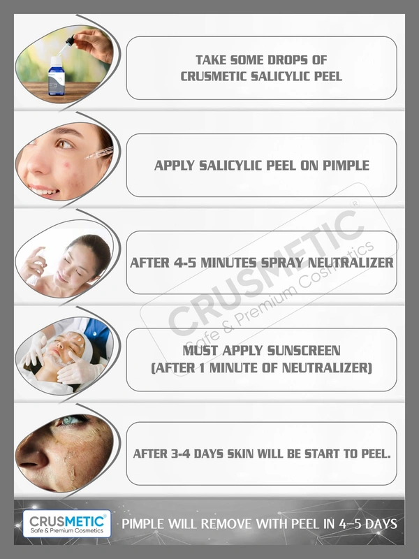 Salicylic Peel 30% For Pimples 10 ML