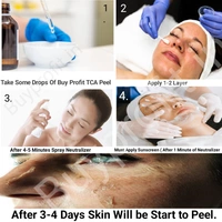 TCA 25 % Peel For Scars, Dark spots, Pigmentation, Peeling Etc