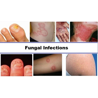 Fungal Infection Cream