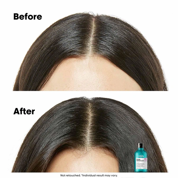 Loreal Professionnel Paris Loreal Professionnel Scalp Advanced Anti-Discomfort Shampoo 300ml |For Sensitive Scalp