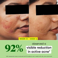 Dot & Key CICA + 2% Salicylic Skin Clearing Face Serum | With Zink & Cactus Water | for Acne & Clear Skin | Serum for Oily ,Acne - Prone Skin & Sensitive Skin | Non Greasy & Non Sticky | 30ml