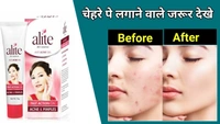 Alite Anti Acne Gel (15 Gms) 