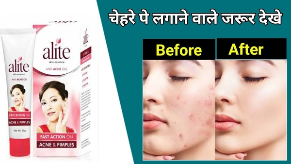 Alite Anti Acne Gel (15 Gms) 