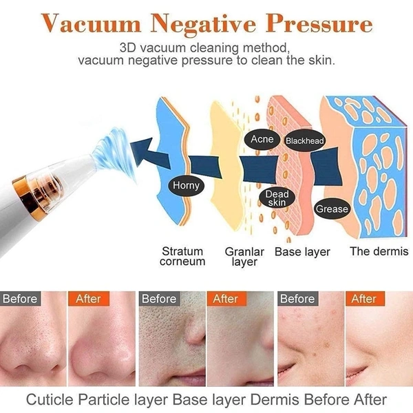 Acne Treatment Device 6 In 1 