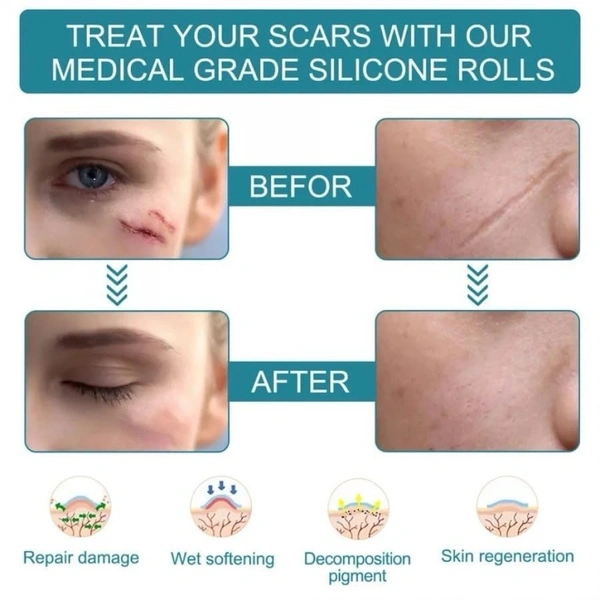 Silicone scar tape for surgical scars Removal 