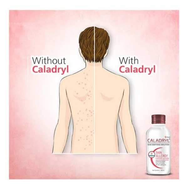 Caladryl Skin Allergy Lotion 