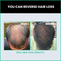 HAIR SERUM 2.0 HAIR GROWTH SERUM FOR MEN AND WOMEN (50 ML) PACK OF @ - 2